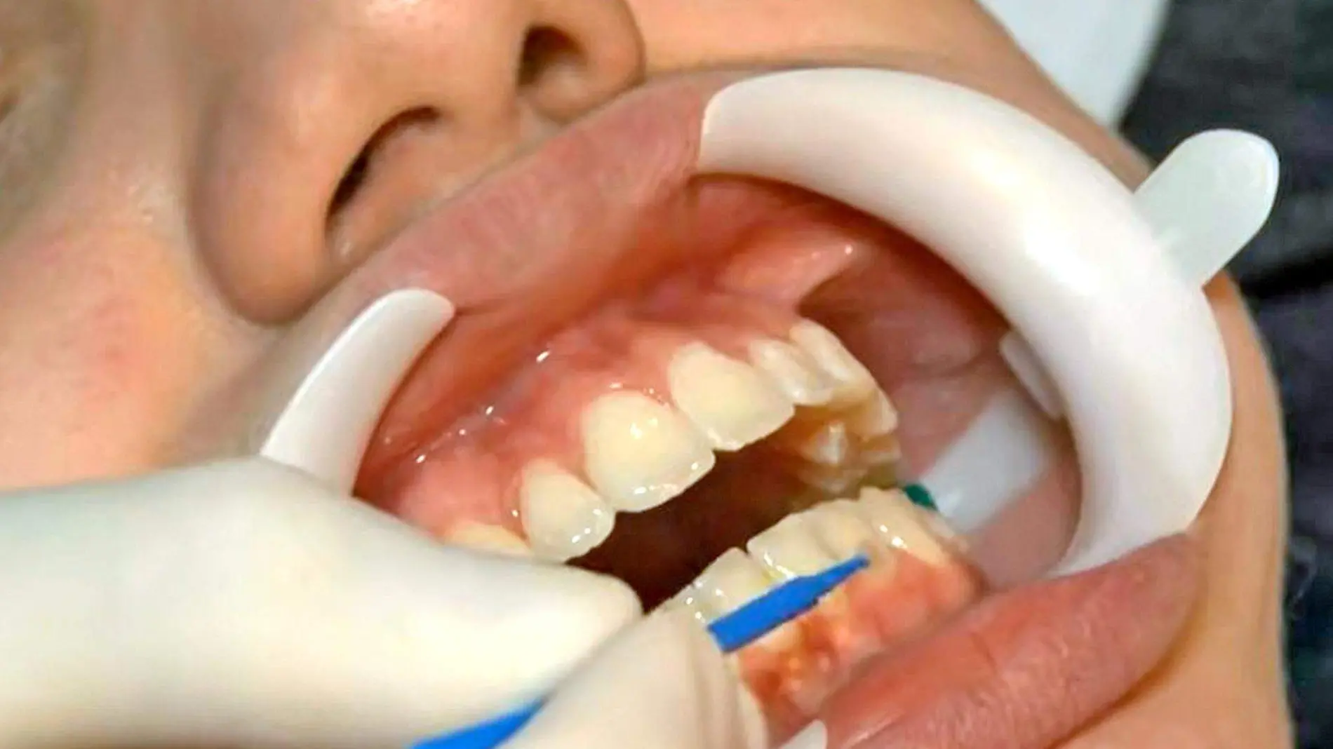 boca de persona en dentista